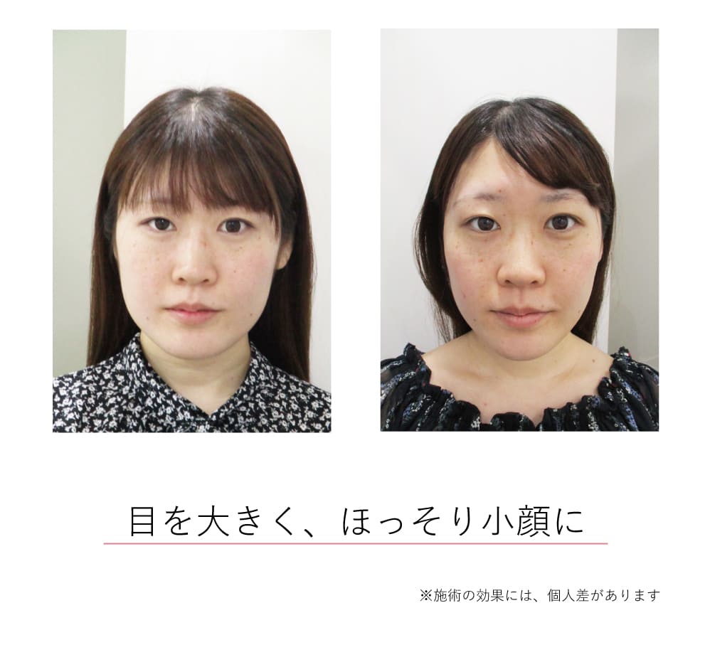 小顔矯正効果イメージ