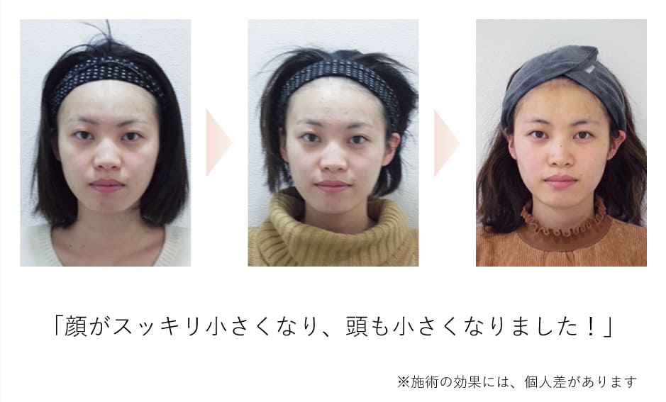 小顔矯正効果イメージ