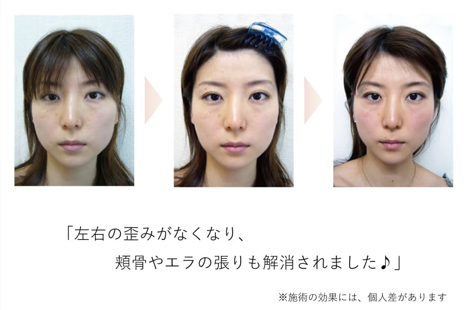 小顔矯正効果イメージ