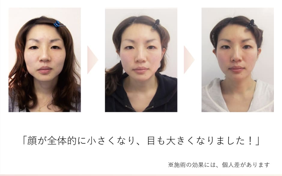 小顔矯正効果イメージ