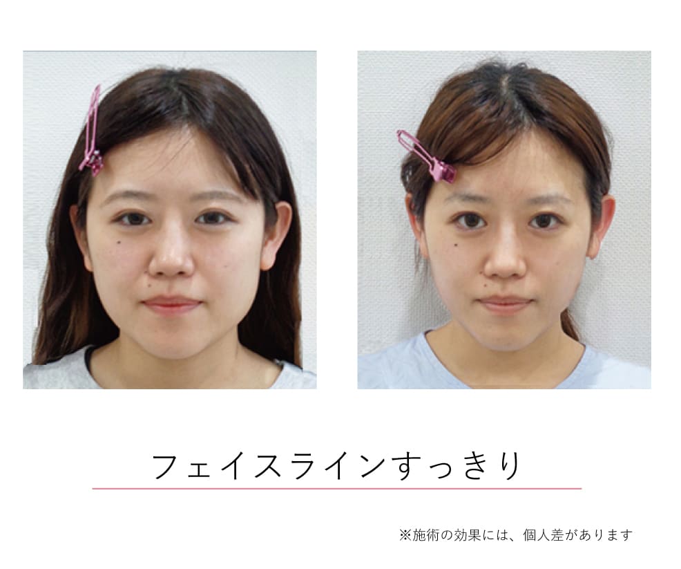 小顔矯正効果イメージ